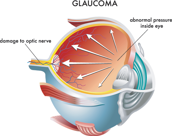 Glaucoma in Westford